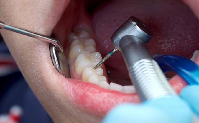 root canal surgery