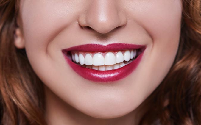 Porcelain Veneers