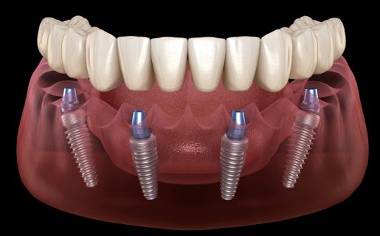 How Are Dental Implants Fitted